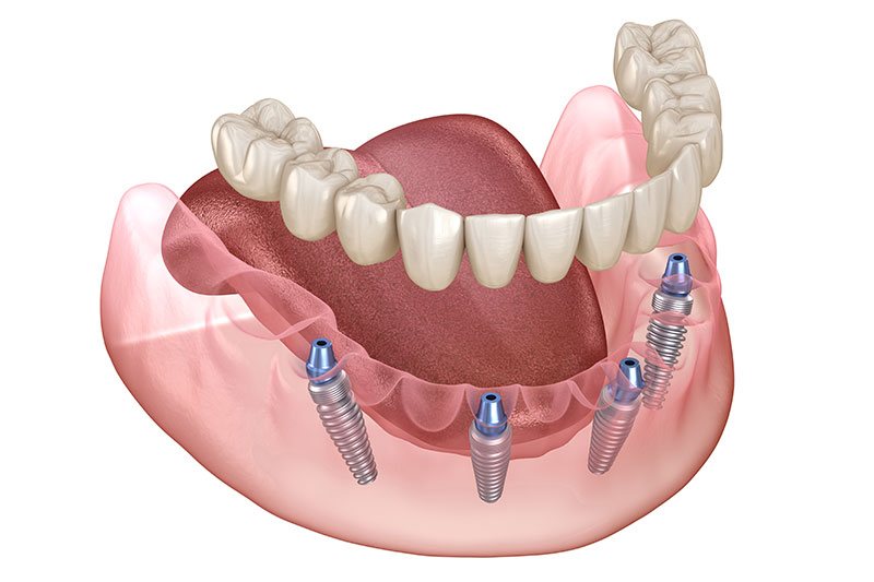 All on X Dental Implants in Kingsburg