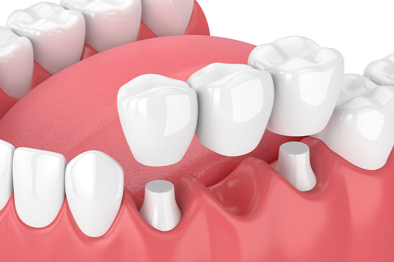 Zirconia Fixed Dental Bridges in Kingsburg