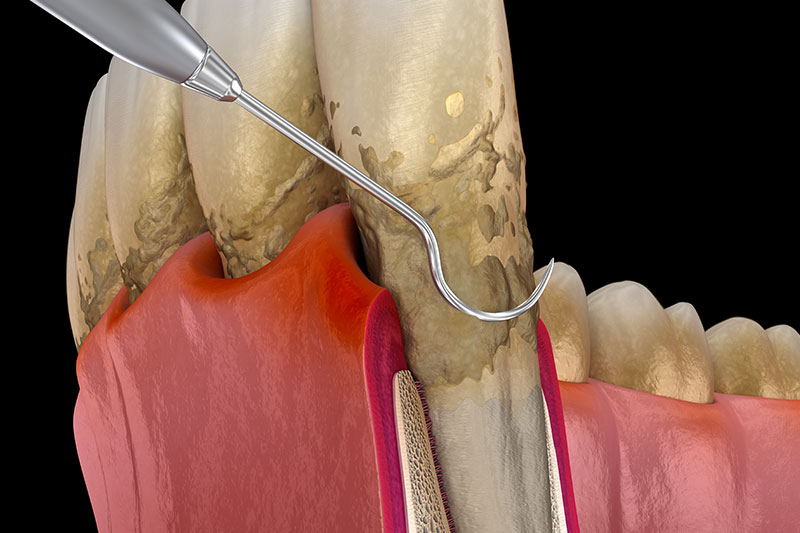 Periodontal Treatments in Kingsburg