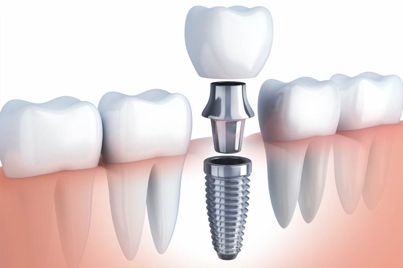 Implants Dentist in Kingsburg