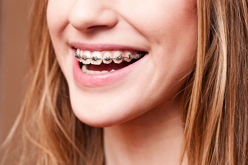 Orthodontics in Kingsburg