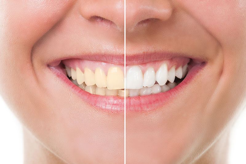 Teeth Whitening in Kingsburg